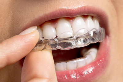 Invisalign Braces